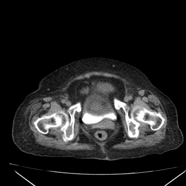 Acute tubular necrosis (Radiopaedia 28077-28334 Axial non-contrast 66).jpg