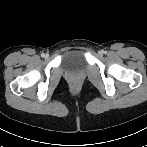 Acute uncomplicated appendicitis (Radiopaedia 61374-69304 Axial C+ portal venous phase 130).jpg