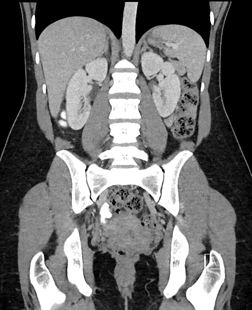 Acute uncomplicated appendicitis (Radiopaedia 61374-69304 Coronal C+ portal venous phase 66).jpg