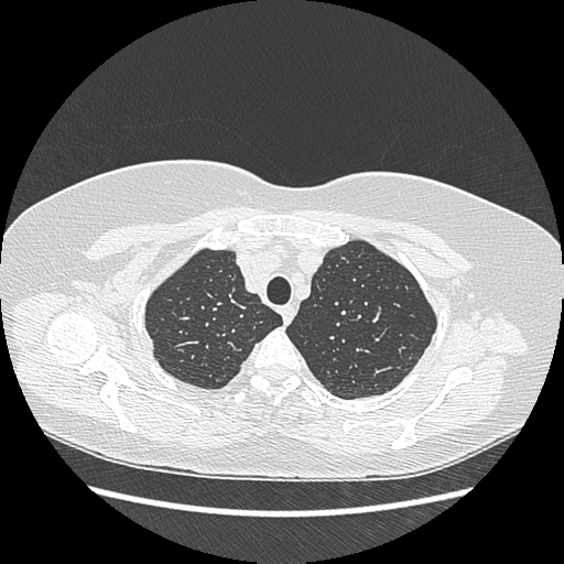 Adenocarcinoma in situ of lung (Radiopaedia 38685-40829 B 42).png