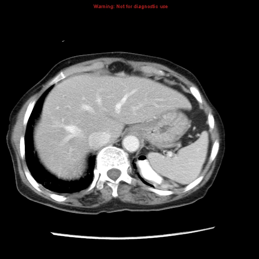 File:Adenocarcinoma of the colon (Radiopaedia 8191-9039 Axial liver window 14).jpg