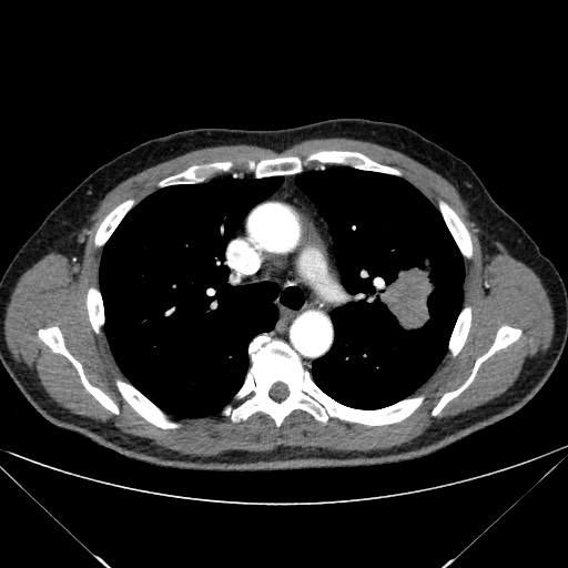 File:Adenocarcinoma of the lung (Radiopaedia 59871-67325 Axial C+ arterial phase 35).jpg