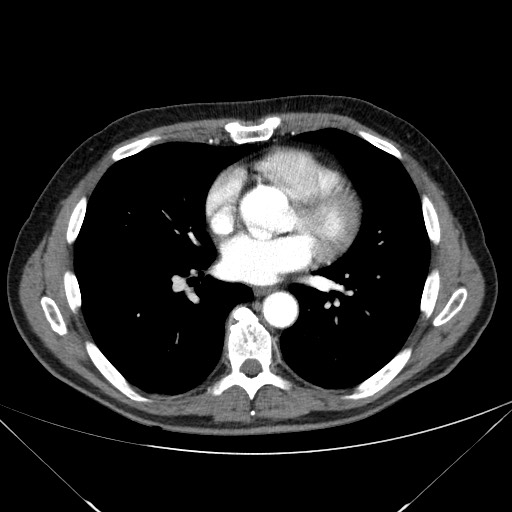 File:Adenocarcinoma of the lung (Radiopaedia 59871-67325 Axial C+ arterial phase 54).jpg