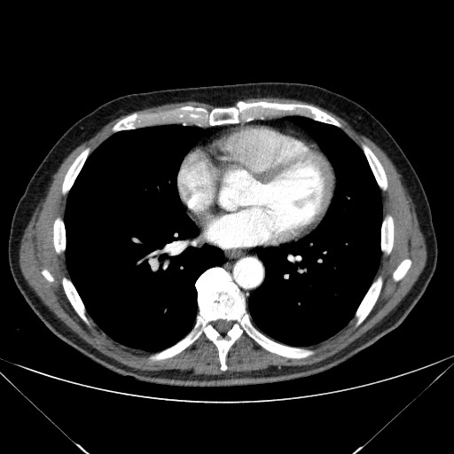 File:Adenocarcinoma of the lung (Radiopaedia 59871-67325 Axial C+ arterial phase 58).jpg