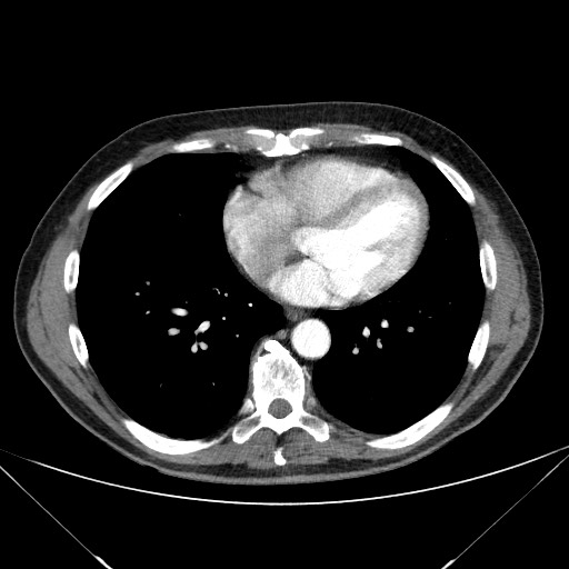 File:Adenocarcinoma of the lung (Radiopaedia 59871-67325 Axial C+ arterial phase 62).jpg