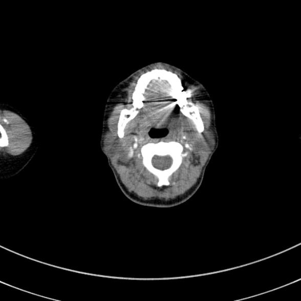 File:Adenocystic carcinoma of the trachea (Radiopaedia 47677-52525 Axial C+ arterial phase 10).jpg