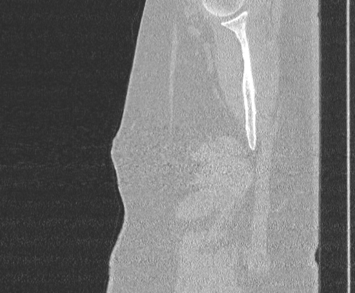 Adenoid cystic carcinoma of the trachea (Radiopaedia 49042-54137 Sagittal lung window 8).jpg