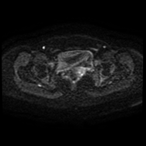 Adenoma malignum of cervix (Radiopaedia 66441-75705 Axial DWI 68).jpg
