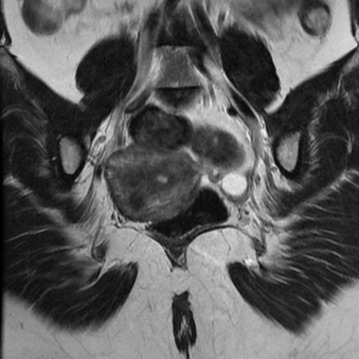 File:Adenoma malignum of cervix (Radiopaedia 66441-75705 Coronal T2 16).jpg