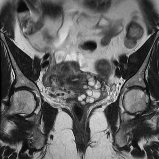 File:Adenoma malignum of cervix (Radiopaedia 66441-75705 Coronal T2 7).jpg