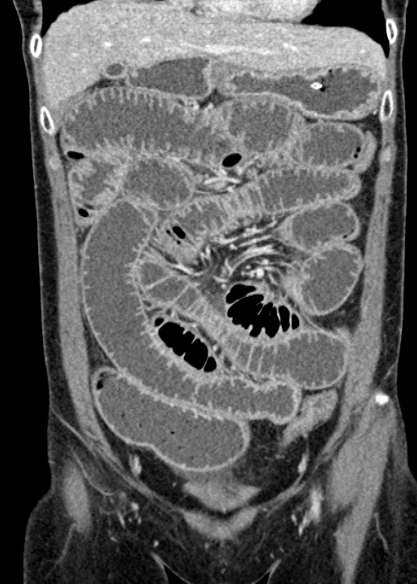Adhesional small bowel obstruction (Radiopaedia 48397-53305 Coronal C+ portal venous phase 111).jpg
