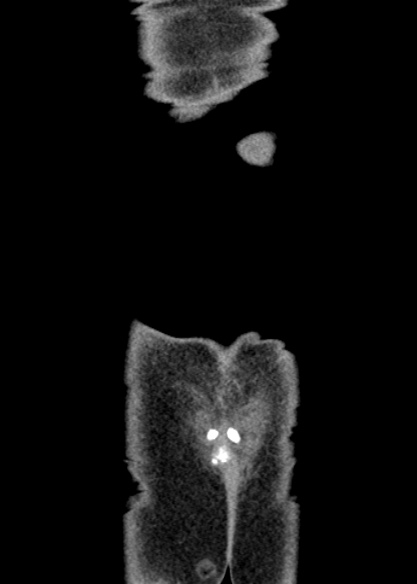 Adhesional small bowel obstruction (Radiopaedia 48397-53305 Coronal C+ portal venous phase 352).jpg