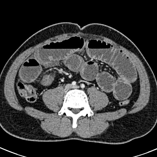 Adhesional small bowel obstruction (Radiopaedia 58900-66131 Axial C+ portal venous phase 32).jpg