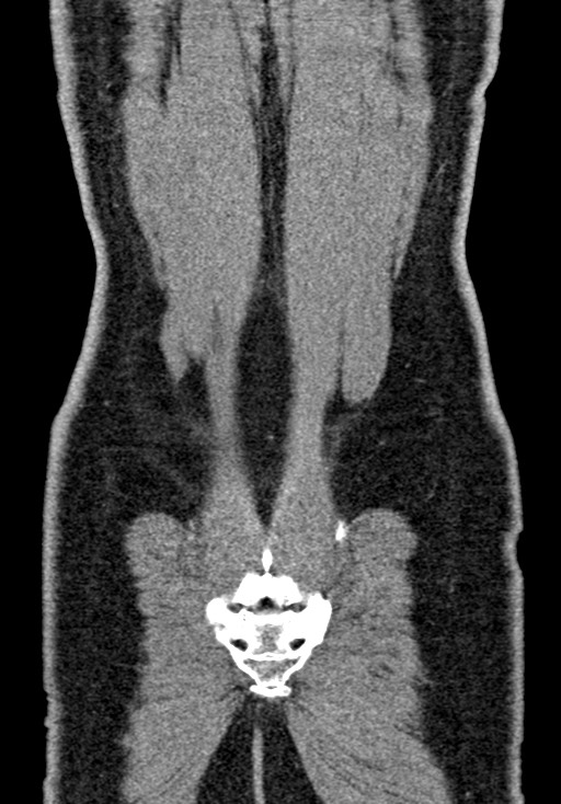 Adhesional small bowel obstruction (Radiopaedia 58900-66131 Coronal C+ portal venous phase 224).jpg