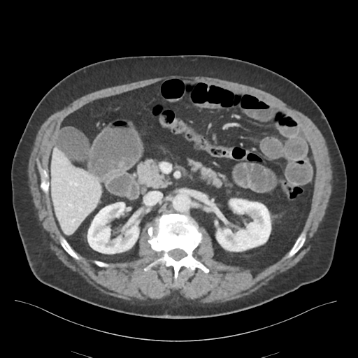 Adhesions within abdominal wall hernia (Radiopaedia 58283-65394 Axial C+ portal venous phase 33).png