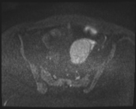 Adnexal multilocular cyst (O-RADS US 3- O-RADS MRI 3) (Radiopaedia 87426-103754 Axial DWI 68).jpg