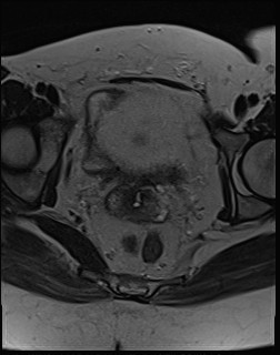 File:Adnexal multilocular cyst (O-RADS US 3- O-RADS MRI 3) (Radiopaedia 87426-103754 Axial T2 17).jpg