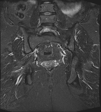 File:Adnexal multilocular cyst (O-RADS US 3- O-RADS MRI 3) (Radiopaedia 87426-103754 Coronal T2 fat sat 23).jpg