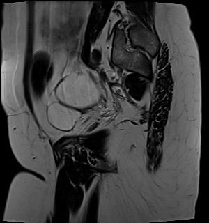 File:Adnexal multilocular cyst (O-RADS US 3- O-RADS MRI 3) (Radiopaedia 87426-103754 Sagittal T2 21).jpg