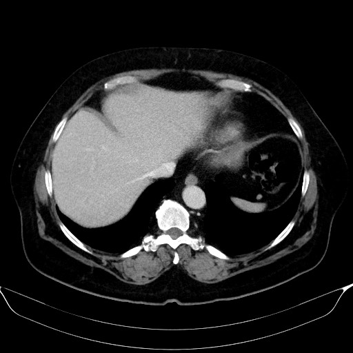 Adrenal cortical carcinoma (Radiopaedia 64017-72769 Axial C+ portal venous phase 8).jpg