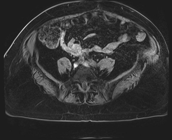 Adrenal cortical carcinoma (Radiopaedia 64017-72770 Axial T1 C+ fat sat 63).jpg