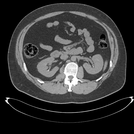 Adrenal cyst (Radiopaedia 45625-49778 Axial non-contrast 48).png