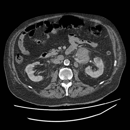 Adrenal lymphoma (Radiopaedia 84145-99415 Axial C+ portal venous phase 57).jpg