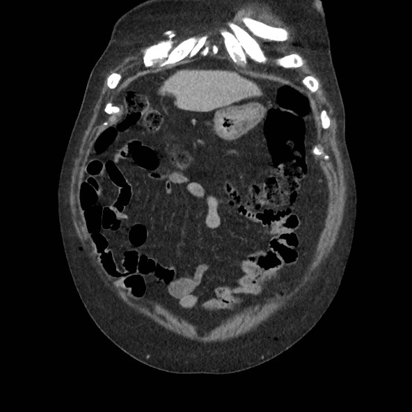 Adrenal lymphoma (Radiopaedia 84145-99415 Coronal C+ portal venous phase 11).jpg