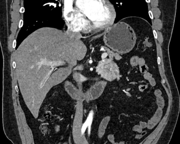 Adrenal metastases (Radiopaedia 73082-83791 Coronal C+ arterial phase 13).jpg