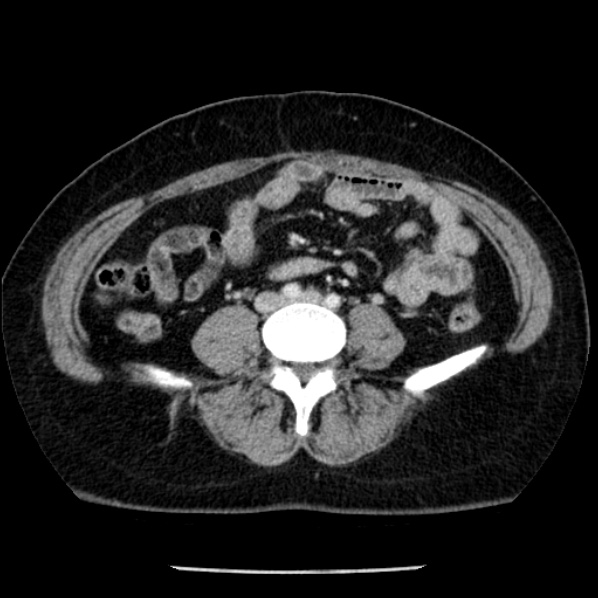 Adrenal myelolipoma (Radiopaedia 43401-46759 Axial C+ portal venous phase 54).jpg
