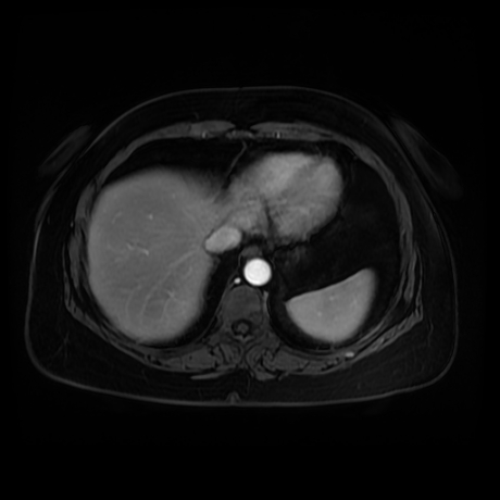 Adrenal myelolipoma - MRI (Radiopaedia 83249-97646 T1 fat sat arterial phase 5).jpg