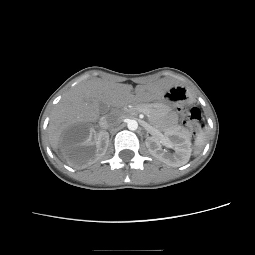 File:Adult polycystic kidney disease (Radiopaedia 48845-53876 Axial renal cortical phase 17).jpg