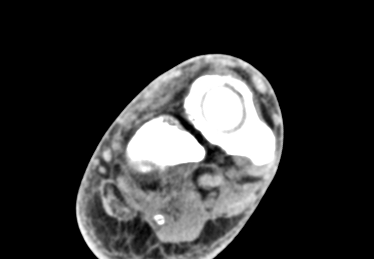 Advanced osteomyelitis due to open metatarsal fracture (Radiopaedia 83891-99095 Axial non-contrast 17).jpg
