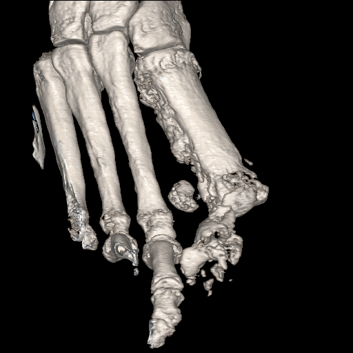 File:Advanced osteomyelitis due to open metatarsal fracture (Radiopaedia 83891-99095 VRT 13).jpg