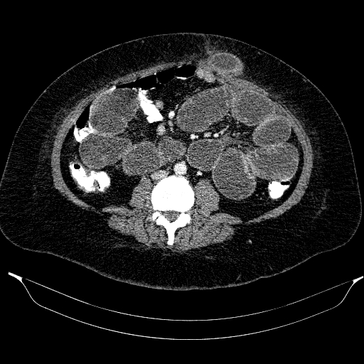 File:Afferent loop syndrome - secondary to incarcerated trocar site hernia (Radiopaedia 82959-97305 Axial C+ portal venous phase 135).jpg