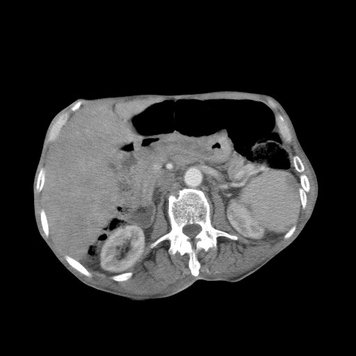 File:Aggressive lung cancer with cardiac metastases, pulmonary artery tumor thrombus, and Budd-Chiari (Radiopaedia 60320-67981 A 63).jpg