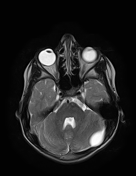 File:Aicardi syndrome (Radiopaedia 66029-75205 Axial T2 7).jpg
