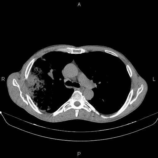 Air bronchogram in pneumonia (Radiopaedia 85719-101512 Axial non-contrast 27).jpg