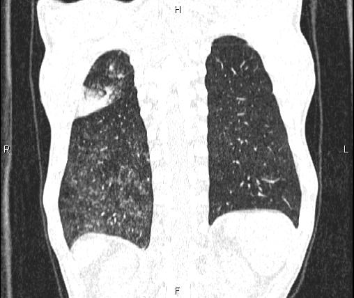 Air bronchogram in pneumonia (Radiopaedia 85719-101512 Coronal lung window 50).jpg
