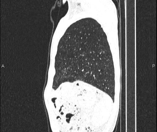 Air bronchogram in pneumonia (Radiopaedia 85719-101512 Sagittal lung window 86).jpg