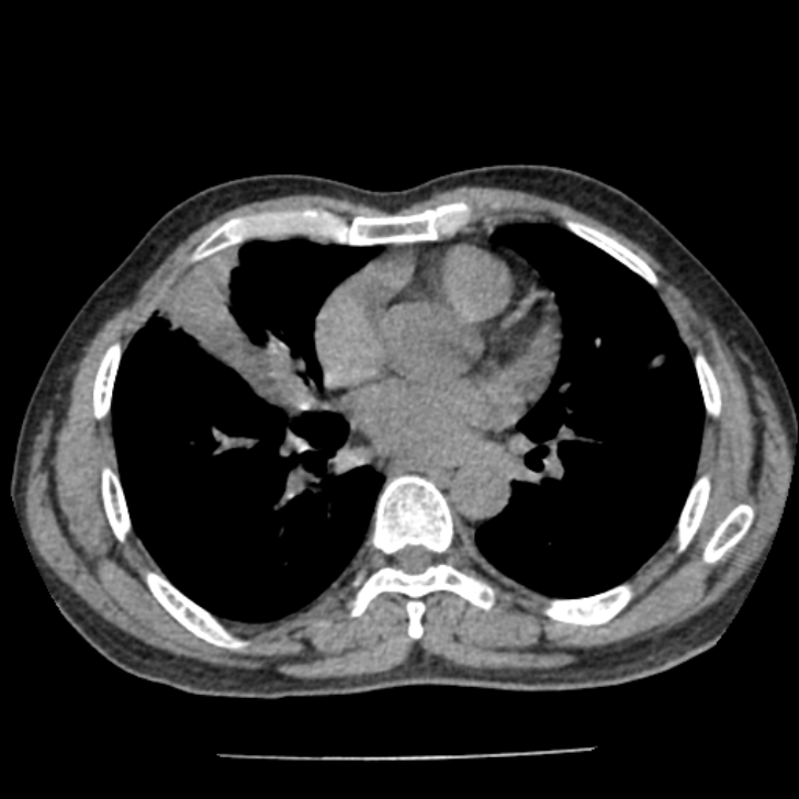 Airway foreign body in adult (Radiopaedia 85907-101779 Axial liver window 105).jpg