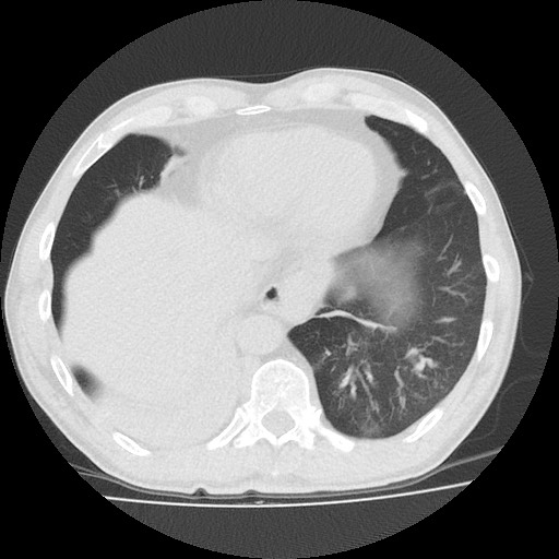 Allergic bronchopulmonary aspergillosis (ABPA) (Radiopaedia 60594-68313 Axial lung window 46).jpg