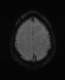 File:Alzheimer's disease- with Gerstmann syndrome and dressing apraxia (Radiopaedia 54882-61150 Axial SWI 30).png
