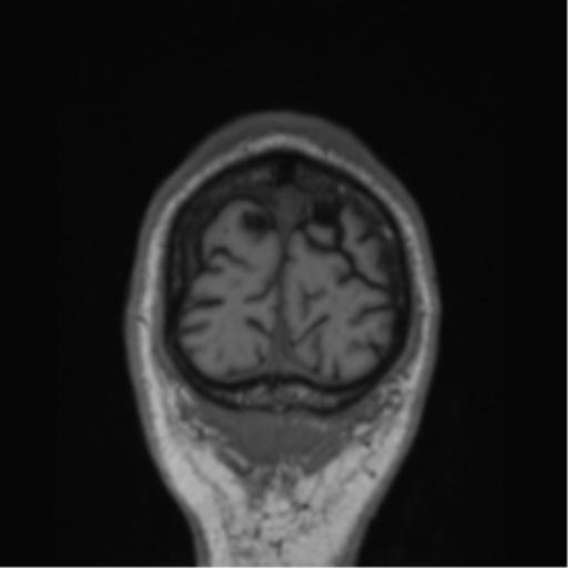 File:Alzheimer's disease- with Gerstmann syndrome and dressing apraxia (Radiopaedia 54882-61150 Coronal T1 7).png