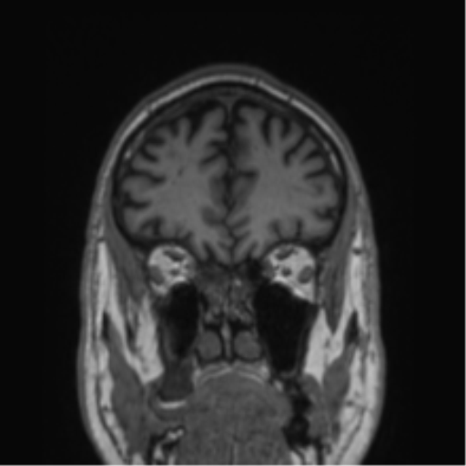 File:Alzheimer's disease- with Gerstmann syndrome and dressing apraxia (Radiopaedia 54882-61150 Coronal T1 72).png