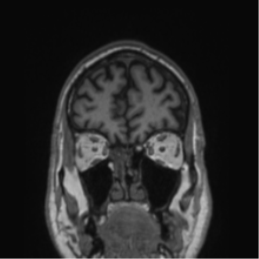 Alzheimer's disease- with Gerstmann syndrome and dressing apraxia (Radiopaedia 54882-61150 Coronal T1 76).png