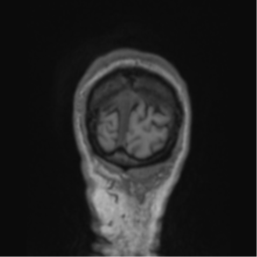 File:Alzheimer's disease- with apraxia (Radiopaedia 54763-61011 Coronal T1 8).png