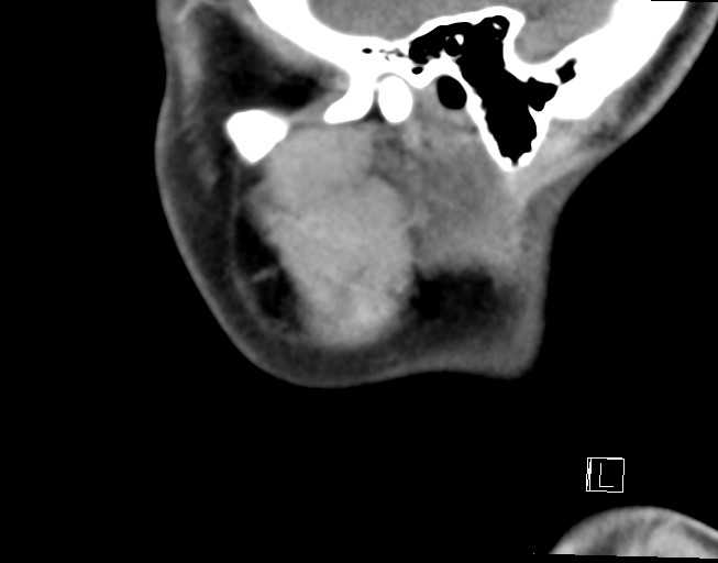 File:Ameloblastoma (Radiopaedia 26645-26793 Sagittal C+ delayed 2).jpg