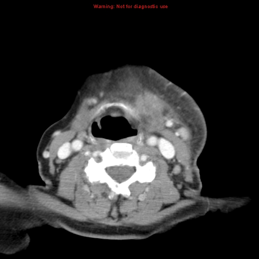 Ameloblastoma (Radiopaedia 27437-27631 A 59).jpg