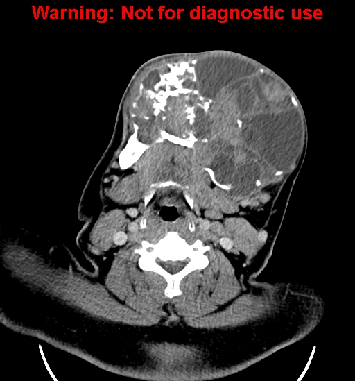 File:Ameloblastoma (Radiopaedia 33126-34164 B 17).jpg